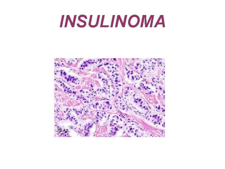 INSULINOMA 