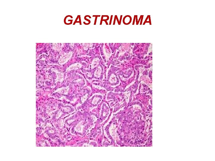 GASTRINOMA 