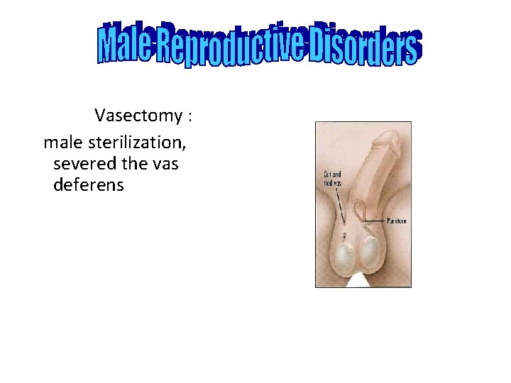 Vasectomy : male sterilization, severed the vas deferens 
