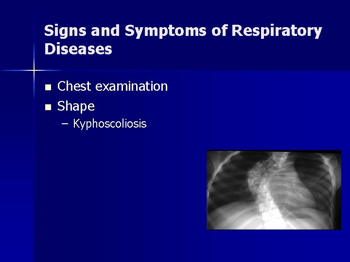 Signs and Symptoms of Respiratory Diseases n n Chest examination Shape – Kyphoscoliosis 