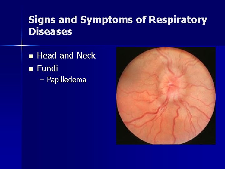 Signs and Symptoms of Respiratory Diseases n n Head and Neck Fundi – Papilledema