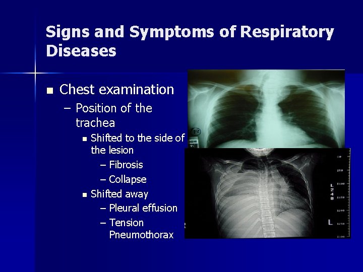 Signs and Symptoms of Respiratory Diseases n Chest examination – Position of the trachea