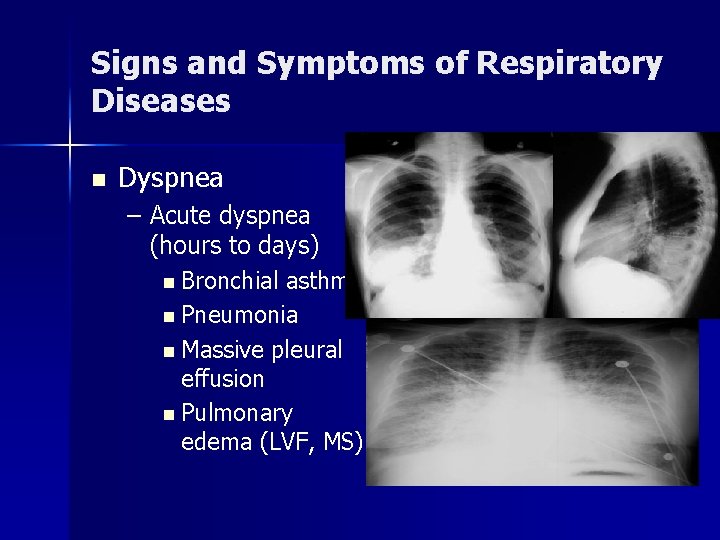 Signs and Symptoms of Respiratory Diseases n Dyspnea – Acute dyspnea (hours to days)