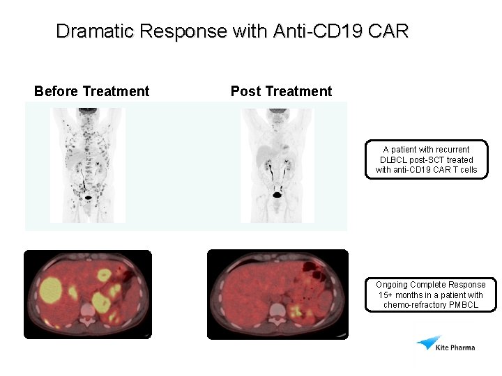 Dramatic Response with Anti-CD 19 CAR Before Treatment Post Treatment A patient with recurrent