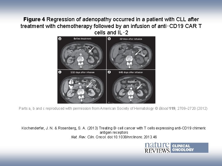 Figure 4 Regression of adenopathy occurred in a patient with CLL after treatment with