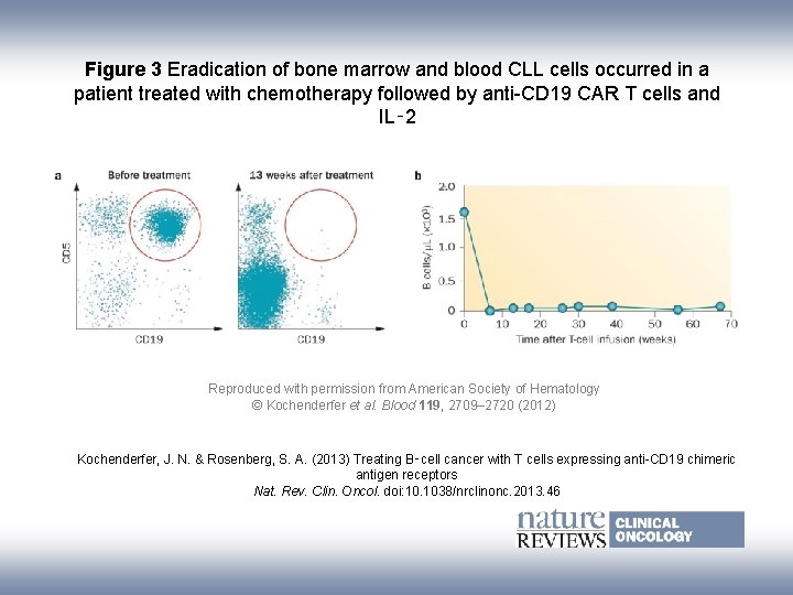 Figure 3 Eradication of bone marrow and blood CLL cells occurred in a patient