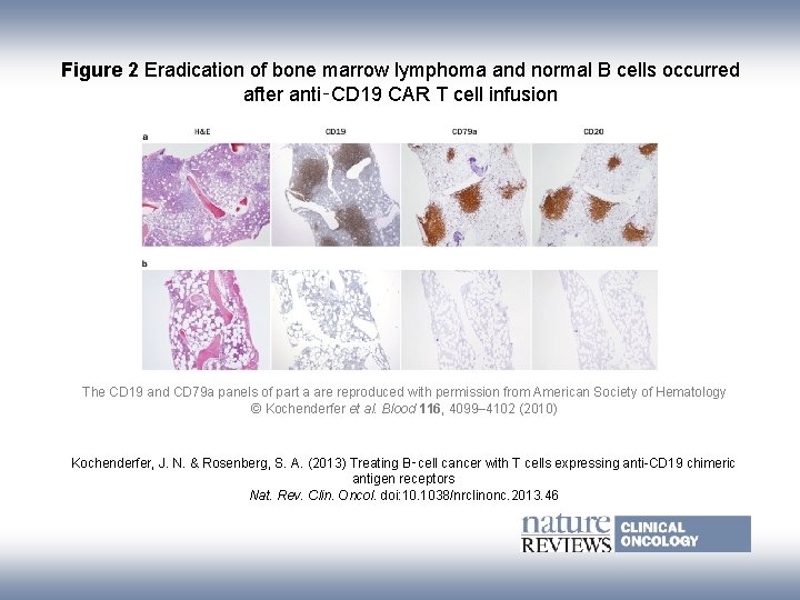 Figure 2 Eradication of bone marrow lymphoma and normal B cells occurred after anti‑CD