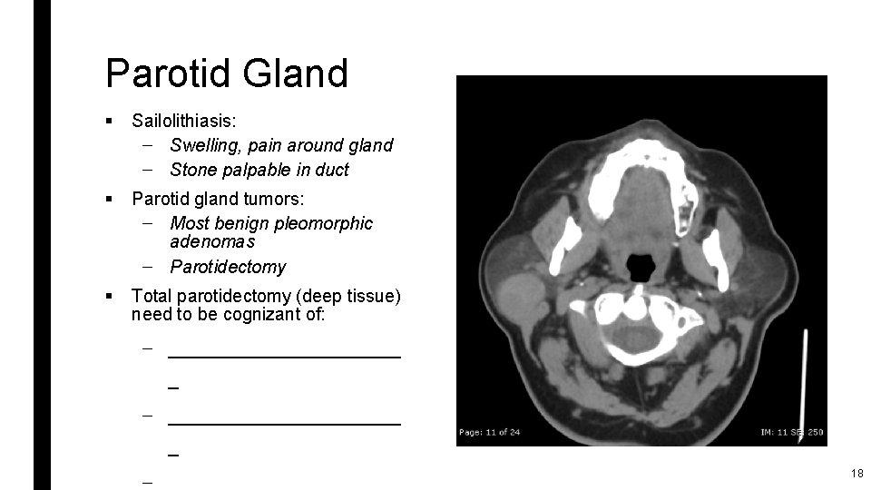 Parotid Gland § Sailolithiasis: – Swelling, pain around gland – Stone palpable in duct