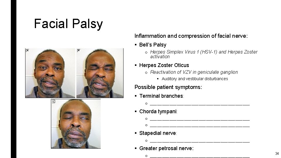 Facial Palsy Inflammation and compression of facial nerve: § Bell’s Palsy o Herpes Simplex
