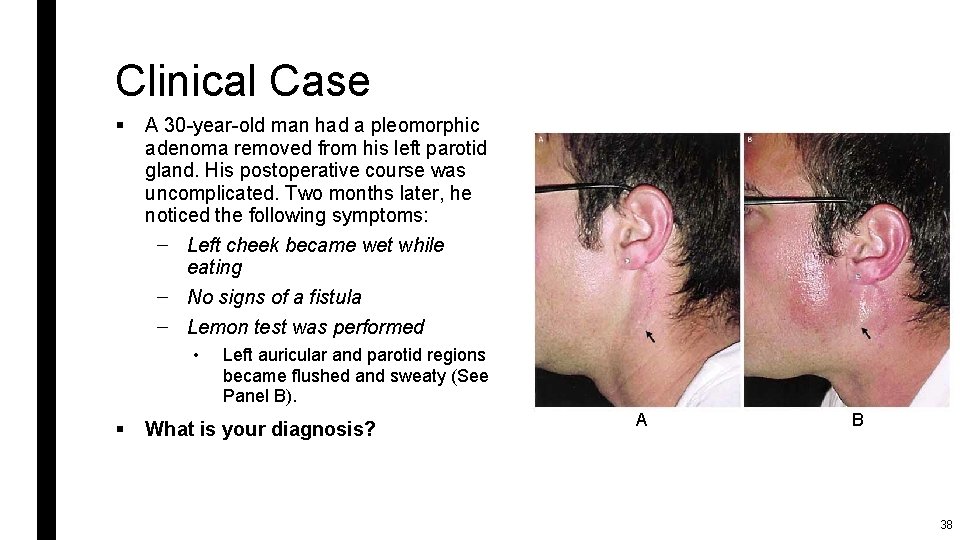 Clinical Case § A 30 -year-old man had a pleomorphic adenoma removed from his