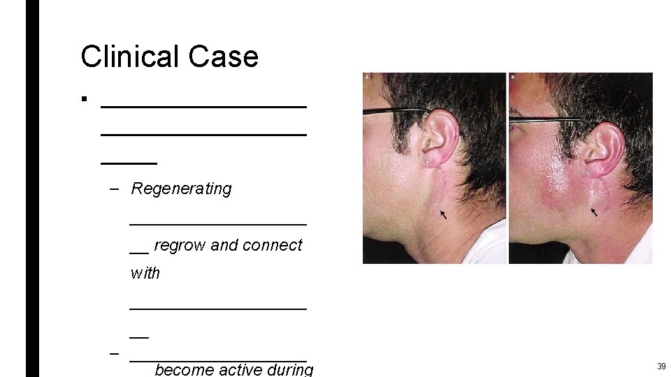 Clinical Case § ______________________ – Regenerating __________ __ regrow and connect with __________ __