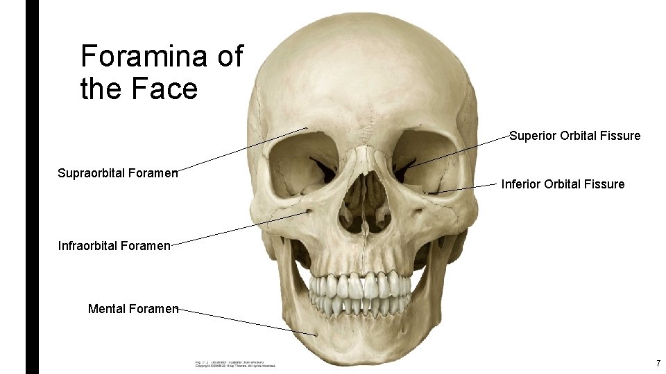 Foramina of the Face Superior Orbital Fissure Supraorbital Foramen Inferior Orbital Fissure Infraorbital Foramen