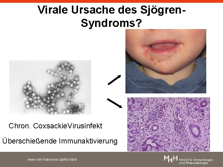 Virale Ursache des Sjögren. Syndroms? Chron. Coxsackie. Virusinfekt Überschießende Immunaktivierung www. mh-hannover. de/kir. html