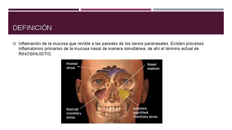 DEFINICIÓN Inflamación de la mucosa que reviste a las paredes de los senos paranasales.