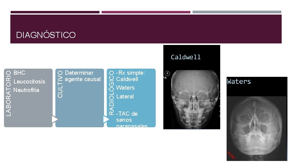 Leucocitosis Neutrofilia Determinar agente causal RADIOLÓGICO BHC CULTIVO LABORATORIO DIAGNÓSTICO -Rx simple: Caldwell Waters