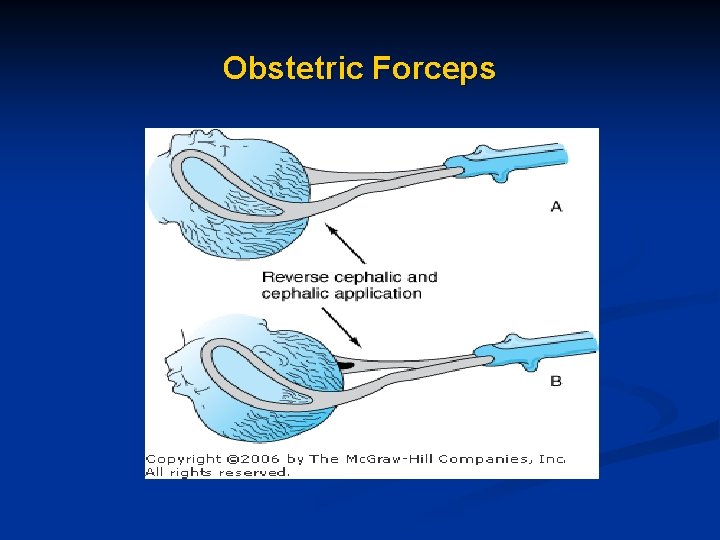 Obstetric Forceps Obstetric Forceps