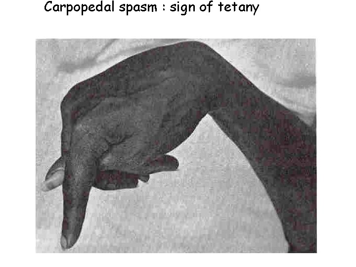 Carpopedal spasm : sign of tetany 