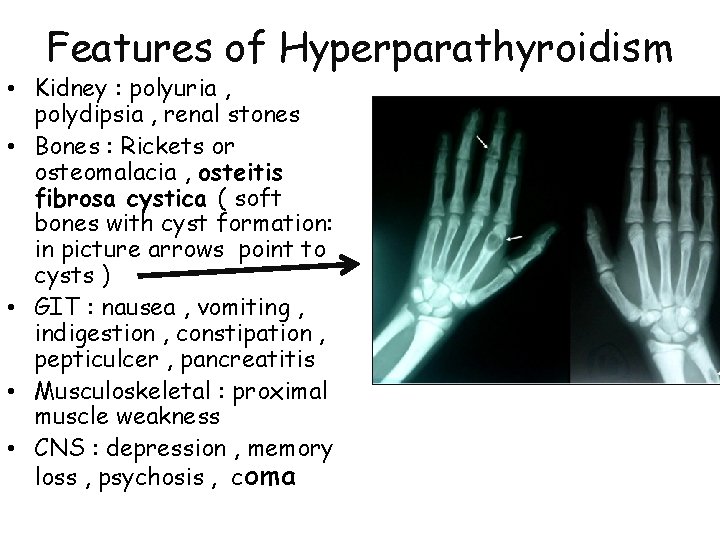 Features of Hyperparathyroidism • Kidney : polyuria , polydipsia , renal stones • Bones