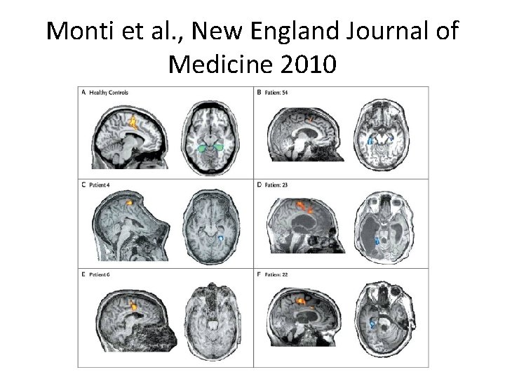 Monti et al. , New England Journal of Medicine 2010 