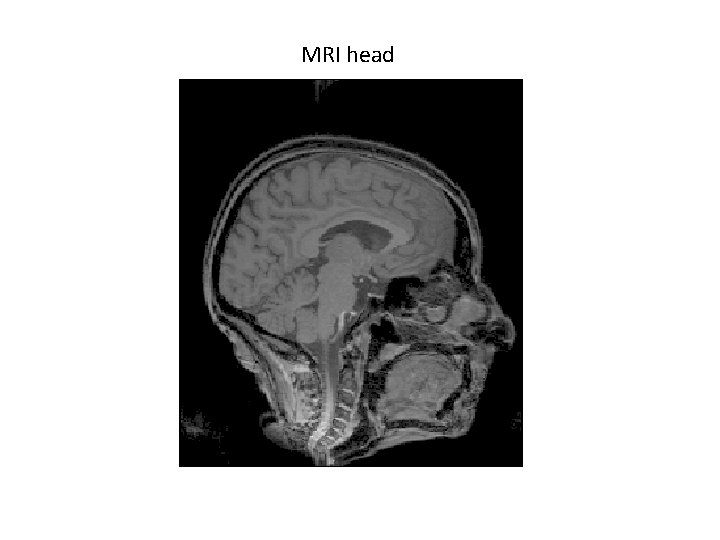 MRI head 