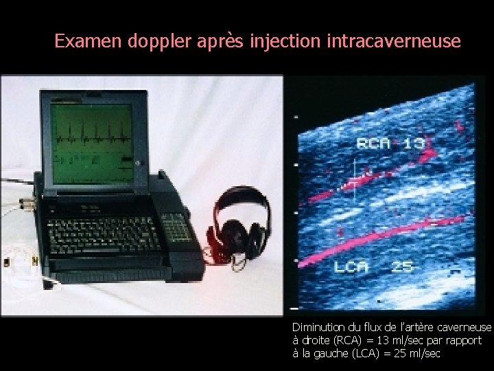 Examen doppler après injection intracaverneuse Diminution du flux de l’artère caverneuse à droite (RCA)
