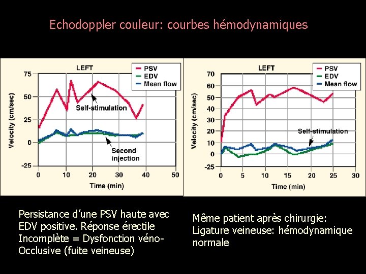 Echodoppler couleur: courbes hémodynamiques Persistance d’une PSV haute avec EDV positive. Réponse érectile Incomplète