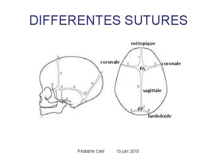 DIFFERENTES SUTURES métopique coronale FA coronale sagittale FP lambdoïde Pédiatrie Creil 15 juin 2010 DIFFERENTES SUTURES métopique coronale FA coronale sagittale FP lambdoïde Pédiatrie Creil 15 juin 2010