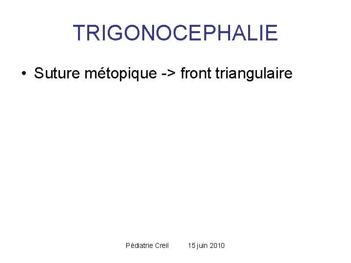 TRIGONOCEPHALIE • Suture métopique -> front triangulaire Pédiatrie Creil 15 juin 2010 TRIGONOCEPHALIE • Suture métopique -> front triangulaire Pédiatrie Creil 15 juin 2010