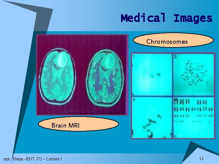 Medical Images Chromosomes Brain MRI xxx Hema –ENT 273 – Lecture 1 12 