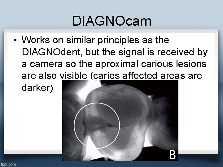 DIAGNOcam • Works on similar principles as the DIAGNOdent, but the signal is received