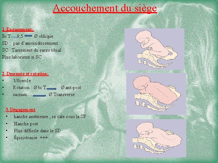 Accouchement du siège 1 -Engagement: Bi T 9, 5 Ø oblique SD : pas