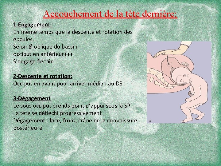 Accouchement de la tète dernière: 1 -Engagement: En même temps que la descente et