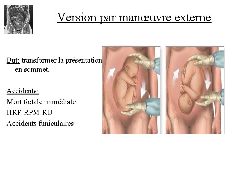 Version par manœuvre externe But: transformer la présentation en sommet. Accidents: Mort fœtale immédiate