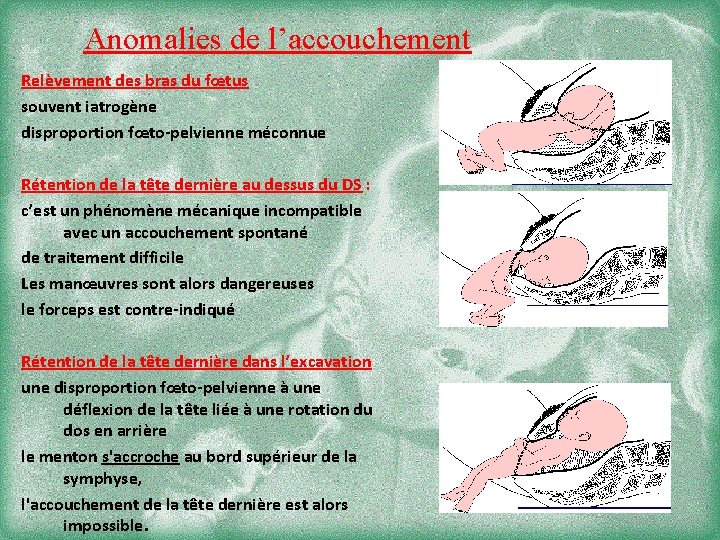 Anomalies de l’accouchement Relèvement des bras du fœtus souvent iatrogène disproportion fœto-pelvienne méconnue Rétention