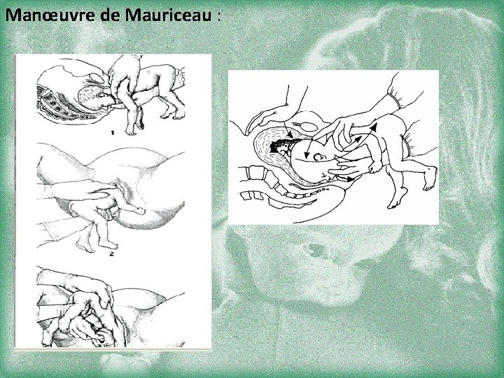 Manœuvre de Mauriceau : 