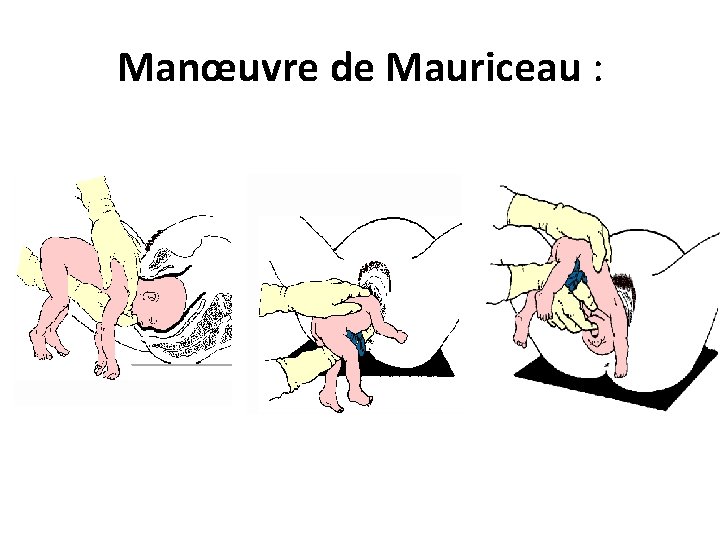 Manœuvre de Mauriceau : 