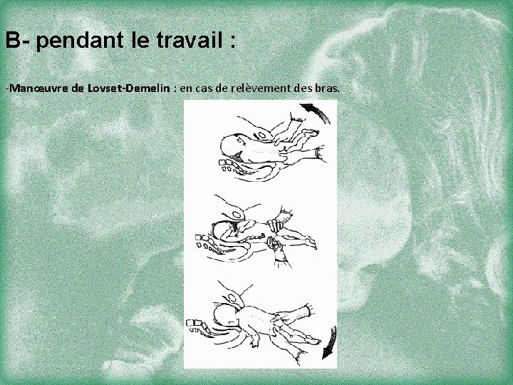 B- pendant le travail : -Manœuvre de Lovset-Demelin : en cas de relèvement des