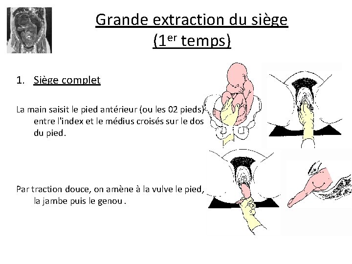 Grande extraction du siège (1 er temps) • Les difficultés varient avec le mode