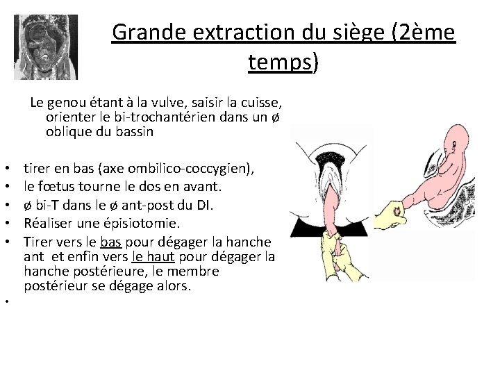 Grande extraction du siège (2ème temps) Le genou étant à la vulve, saisir la