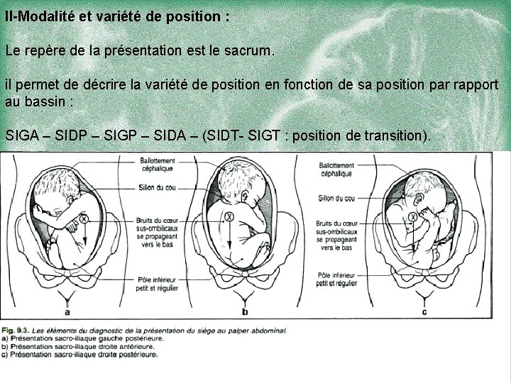 II-Modalité et variété de position : Le repère de la présentation est le sacrum.