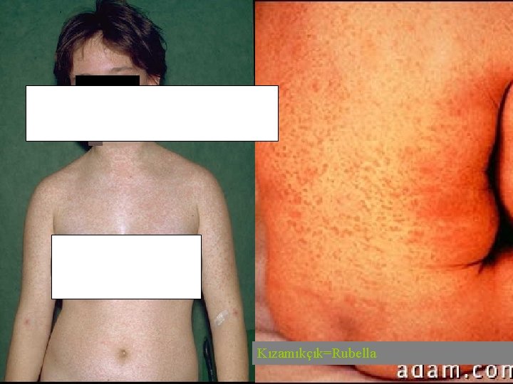 Kızamıkçık=Rubella 