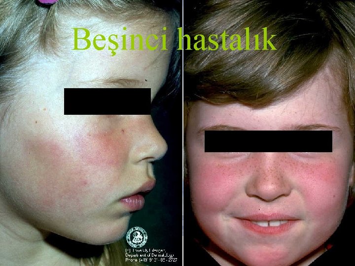 Beşinci hastalık 