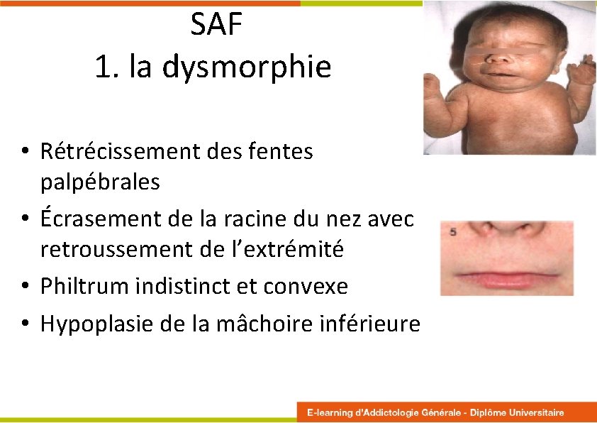  SAF 1. la dysmorphie • Rétrécissement des fentes palpébrales • Écrasement de la