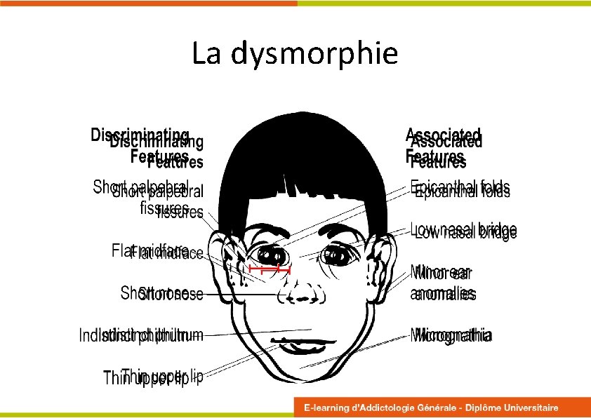 La dysmorphie 