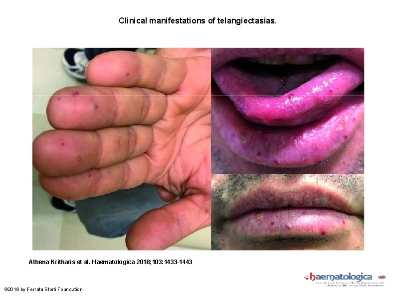 Clinical manifestations of telangiectasias. Athena Kritharis et al. Haematologica 2018; 103: 1433 -1443 ©