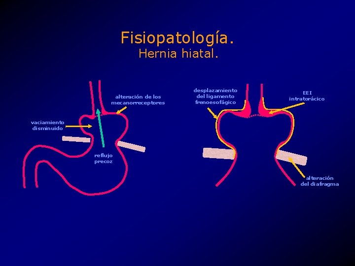 Fisiopatología. Hernia hiatal. alteración de los mecanorreceptores desplazamiento del ligamento frenoesofágico EEI intratorácico vaciamiento