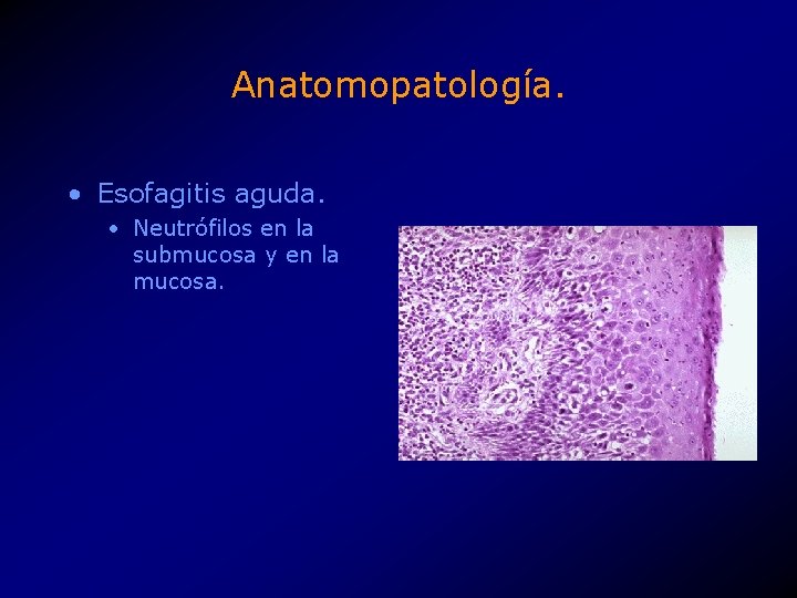 Anatomopatología. • Esofagitis aguda. • Neutrófilos en la submucosa y en la mucosa. 