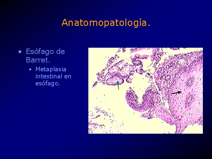 Anatomopatología. • Esófago de Barret. • Metaplasia intestinal en esófago. 