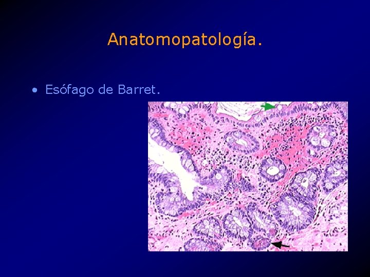 Anatomopatología. • Esófago de Barret. 