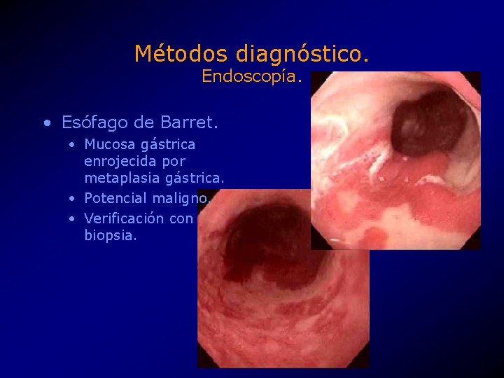 Métodos diagnóstico. Endoscopía. • Esófago de Barret. • Mucosa gástrica enrojecida por metaplasia gástrica.